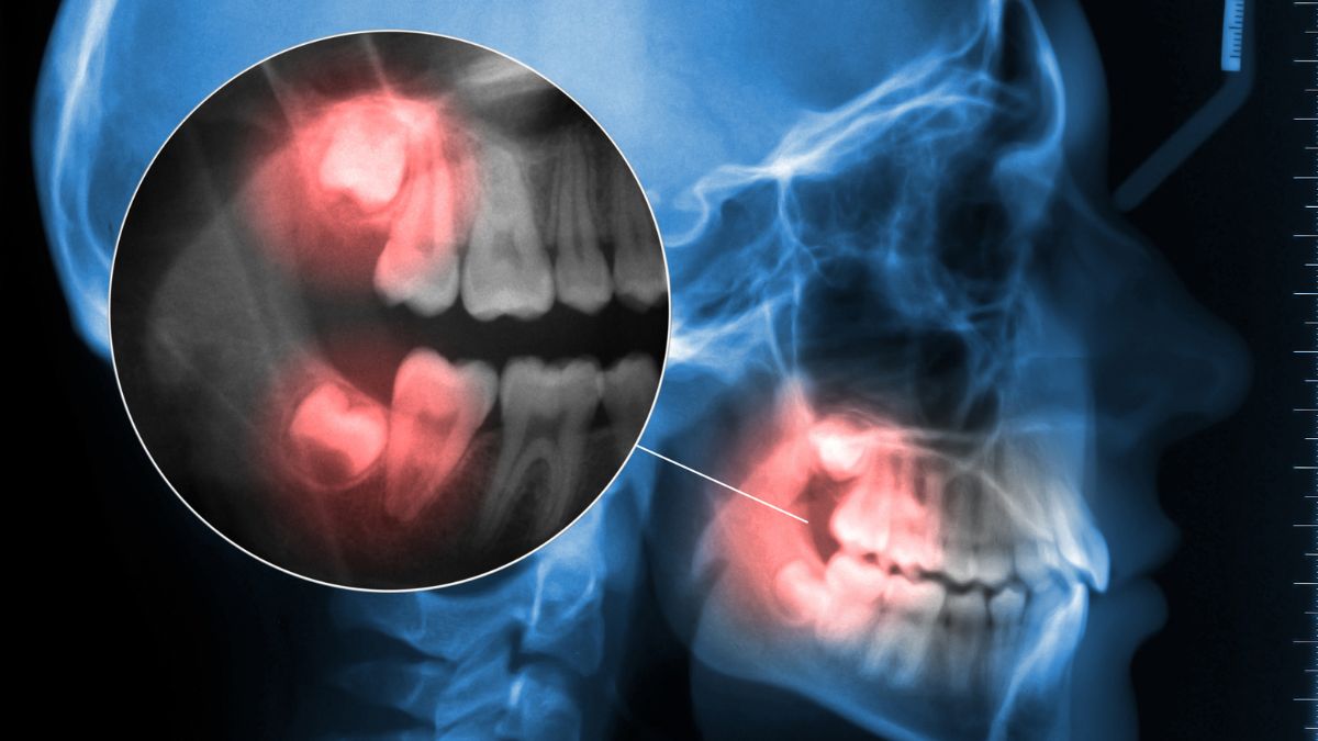 dente del giudizio con inclusione gengivale