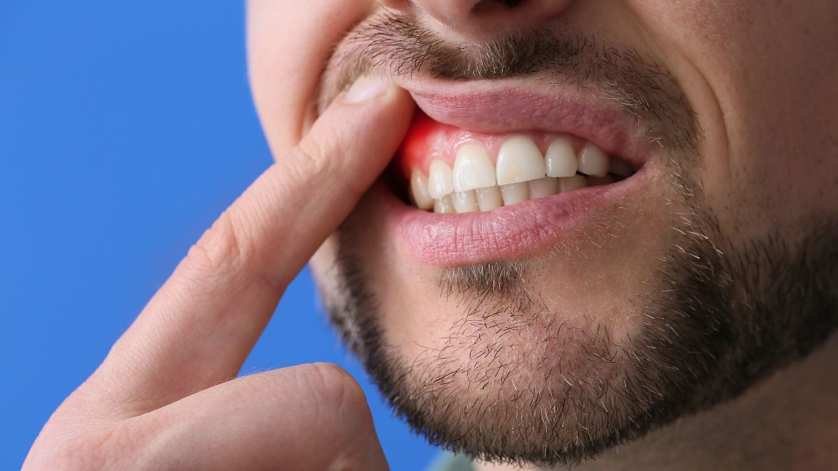 Ascesso dentale